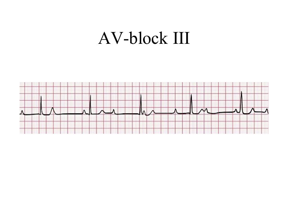 AV-block III
