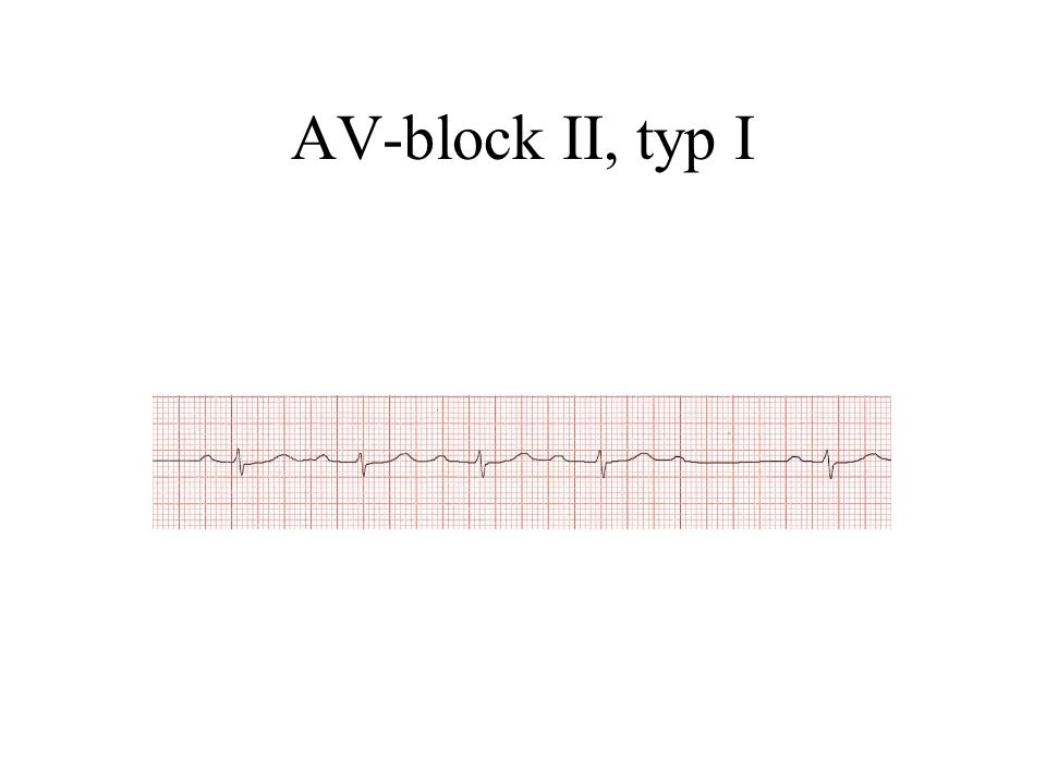 AV-block II, typ I