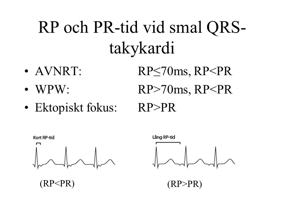 RP och PR-tid vid smal QRS- takykardi AVNRT:RP≤70ms, RP<PR WPW:RP>70ms, RP<PR Ektopiskt fokus:RP>PR (RP>PR) (RP<PR)