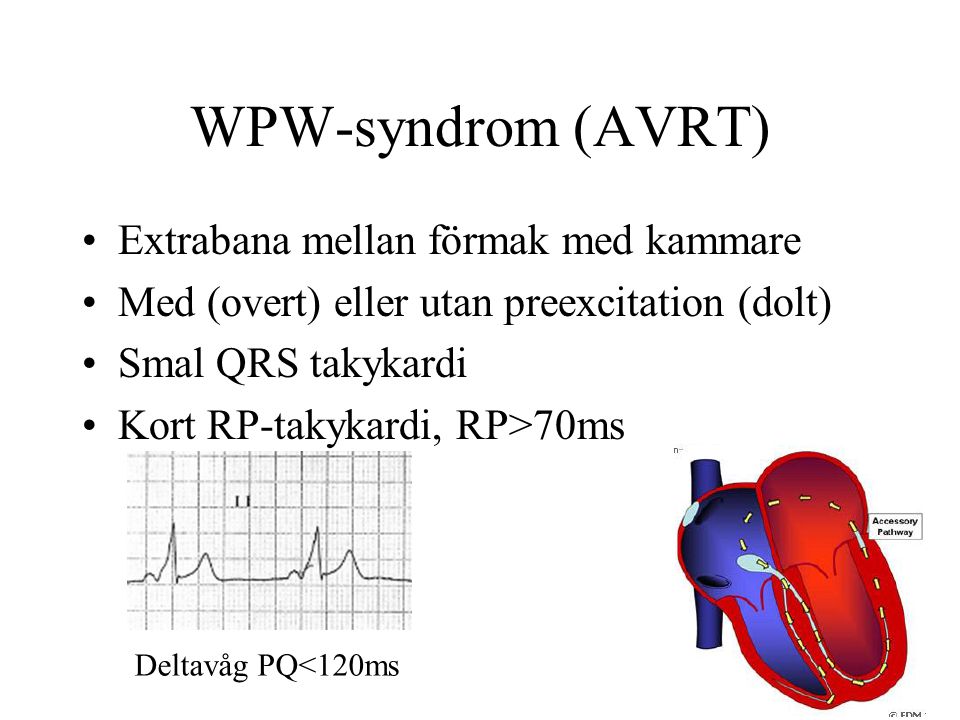 WPW-syndrom (AVRT) Extrabana mellan förmak med kammare Med (overt) eller utan preexcitation (dolt) Smal QRS takykardi Kort RP-takykardi, RP>70ms Deltavåg PQ<120ms