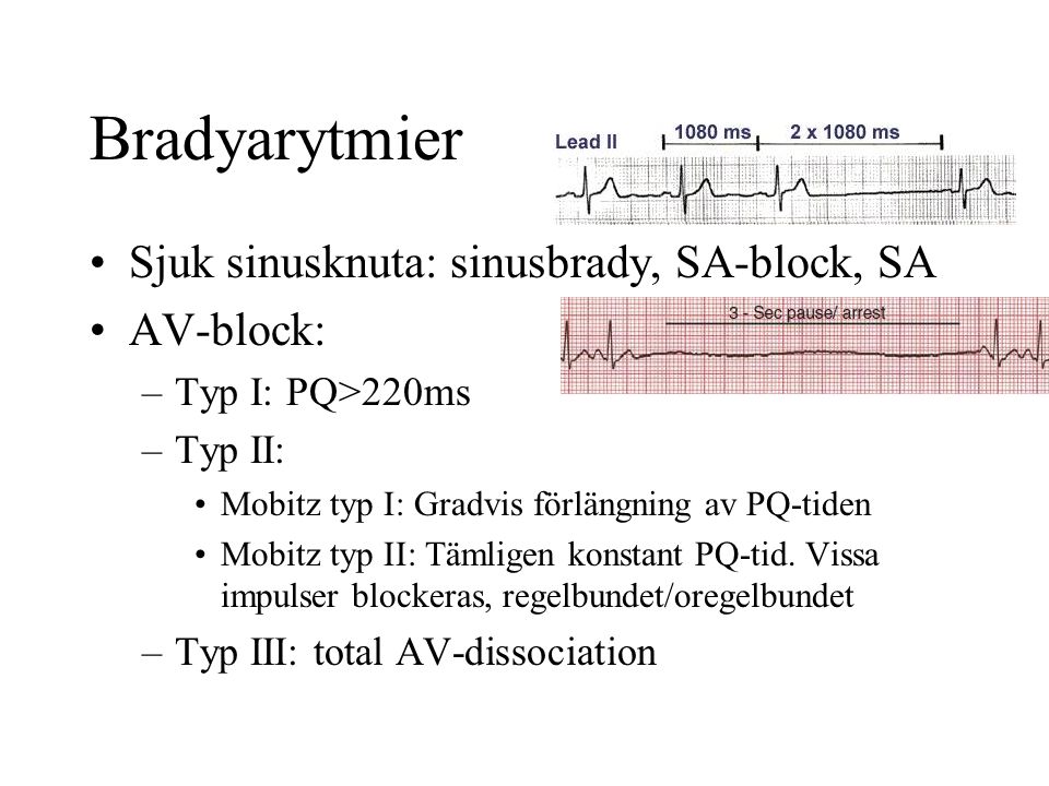 Bradyarytmier Sjuk sinusknuta: sinusbrady, SA-block, SA AV-block: –Typ I: PQ>220ms –Typ II: Mobitz typ I: Gradvis förlängning av PQ-tiden Mobitz typ II: Tämligen konstant PQ-tid.