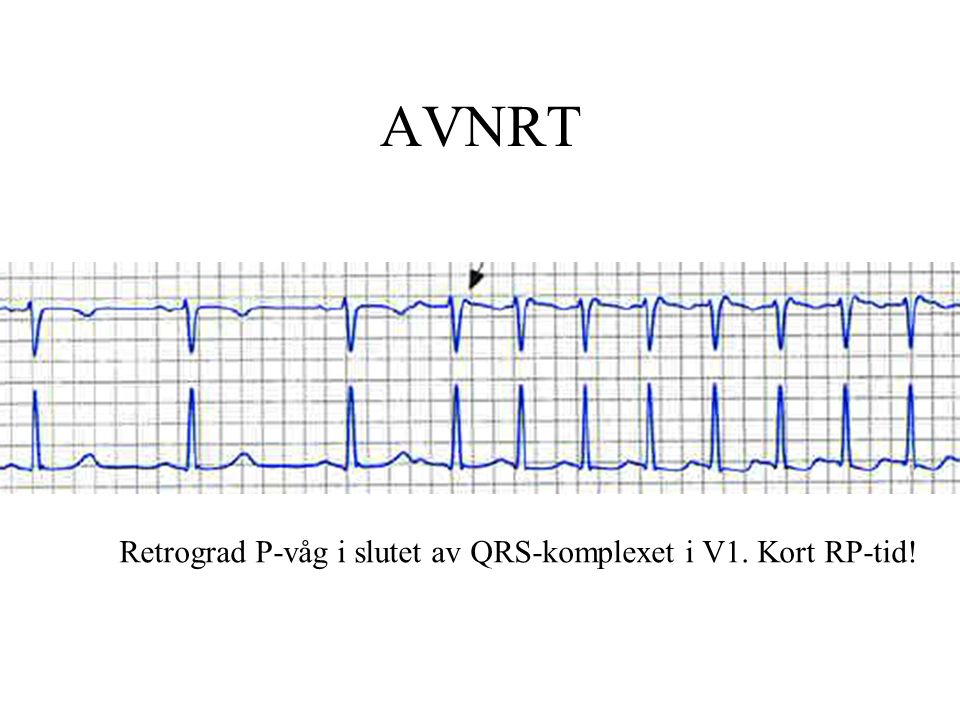 AVNRT Retrograd P-våg i slutet av QRS-komplexet i V1. Kort RP-tid!