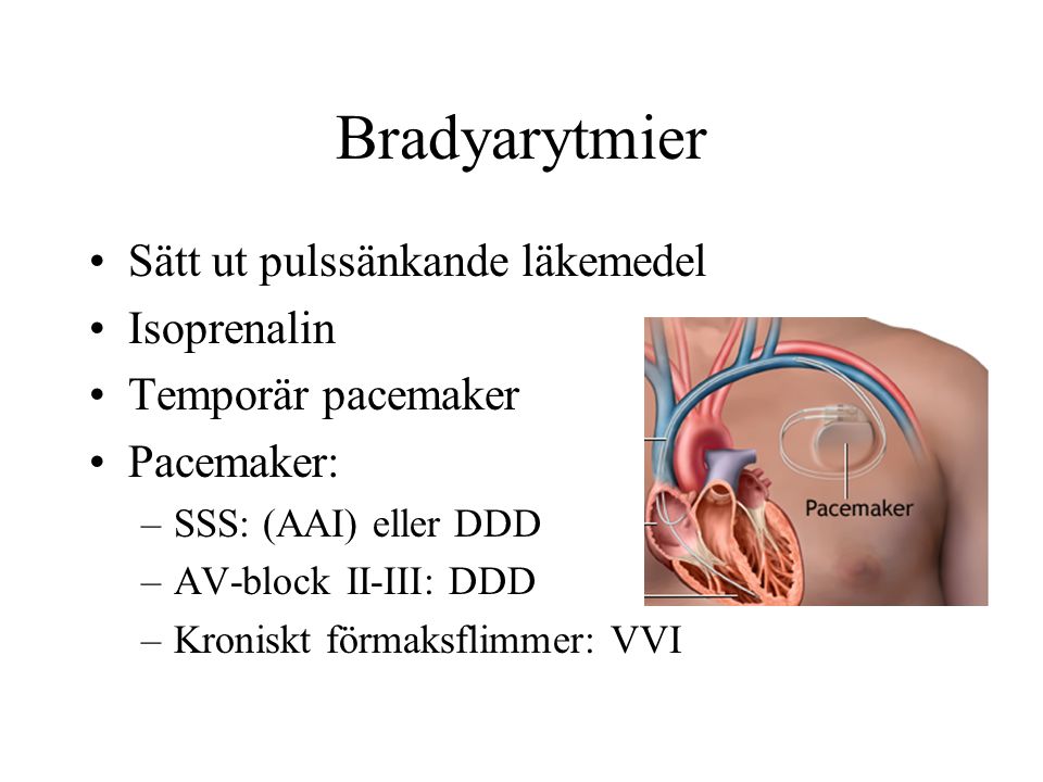 Bradyarytmier Sätt ut pulssänkande läkemedel Isoprenalin Temporär pacemaker Pacemaker: –SSS: (AAI) eller DDD –AV-block II-III: DDD –Kroniskt förmaksflimmer: VVI