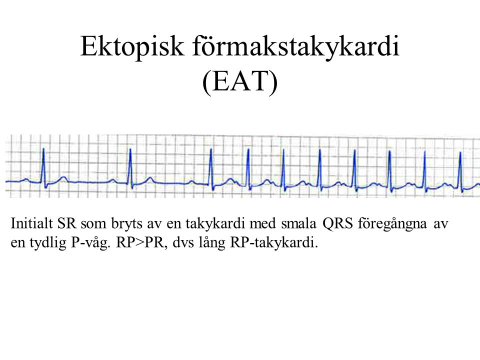 Ektopisk förmakstakykardi (EAT) Initialt SR som bryts av en takykardi med smala QRS föregångna av en tydlig P-våg.