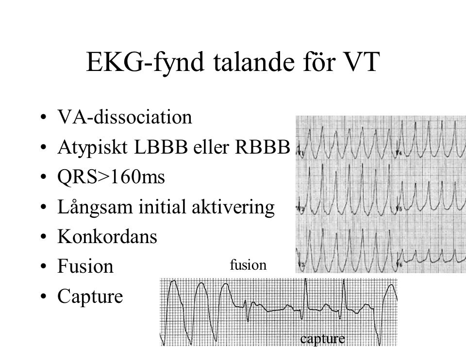 EKG-fynd talande för VT VA-dissociation Atypiskt LBBB eller RBBB QRS>160ms Långsam initial aktivering Konkordans Fusion Capture fusion capture