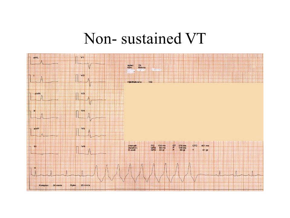 Non- sustained VT