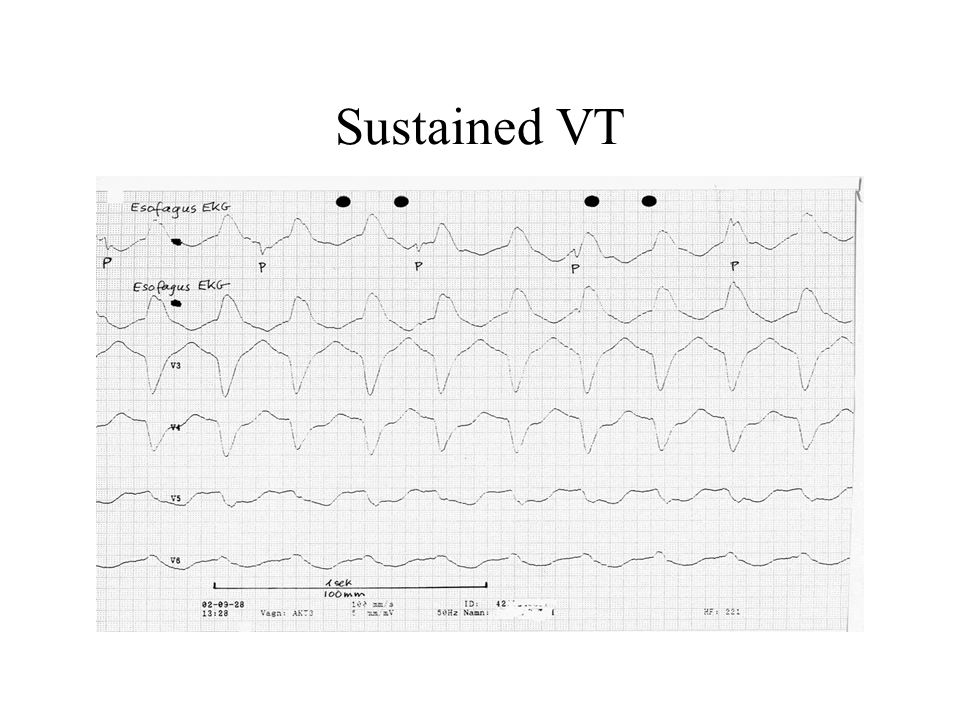 Sustained VT