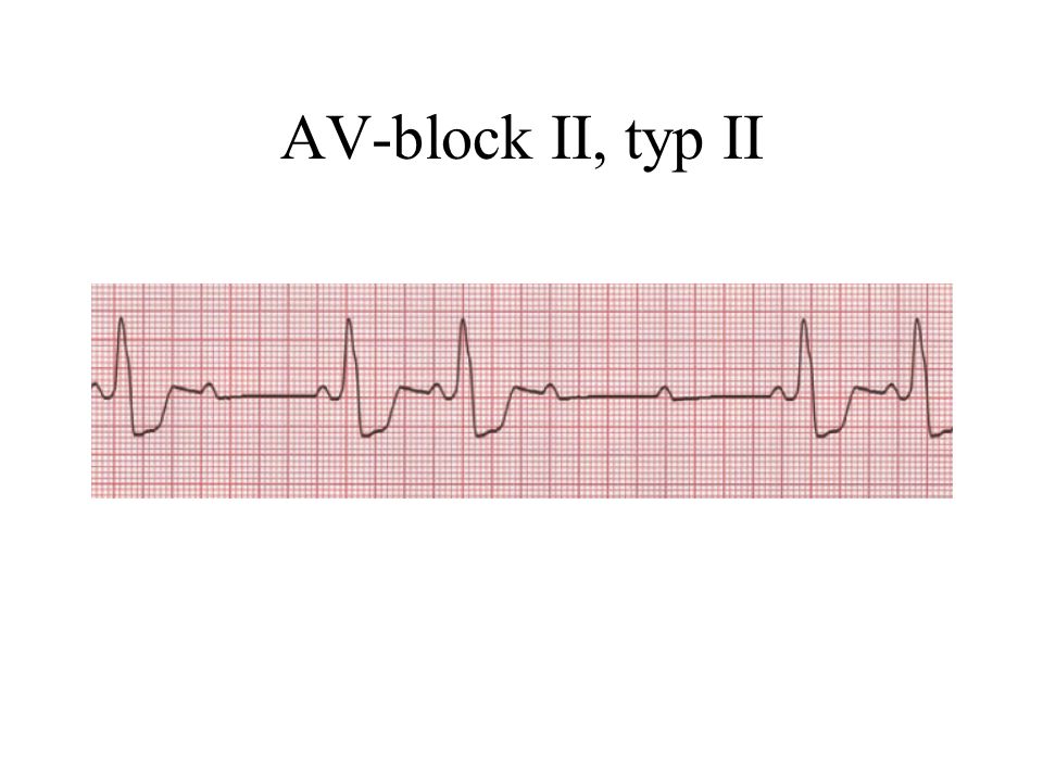 AV-block II, typ II