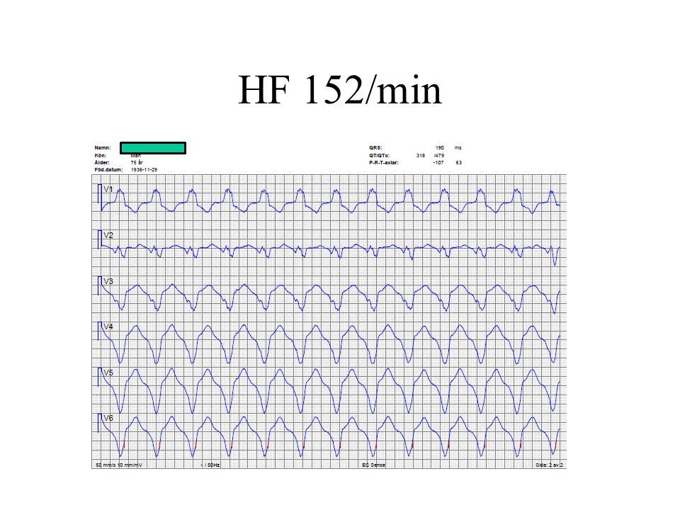 HF 152/min