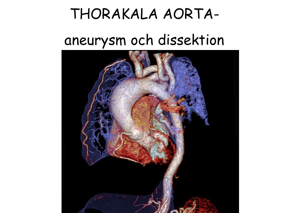 THORAKALA AORTA- aneurysm och dissektion