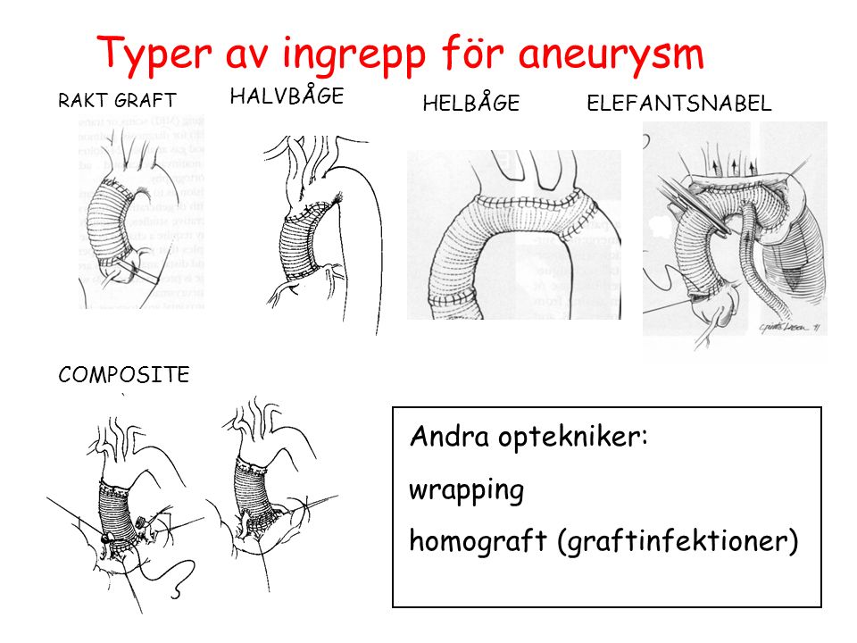 RAKT GRAFT COMPOSITE HALVBÅGE HELBÅGEELEFANTSNABEL Andra optekniker: wrapping homograft (graftinfektioner) Typer av ingrepp för aneurysm