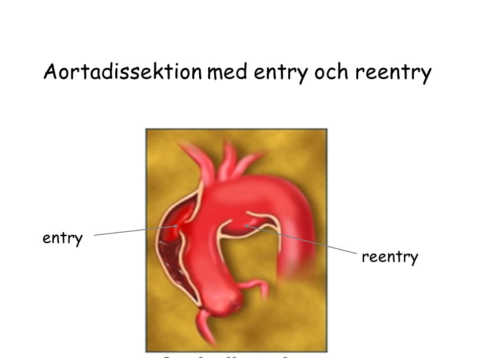 Aortadissektion med entry och reentry entry reentry