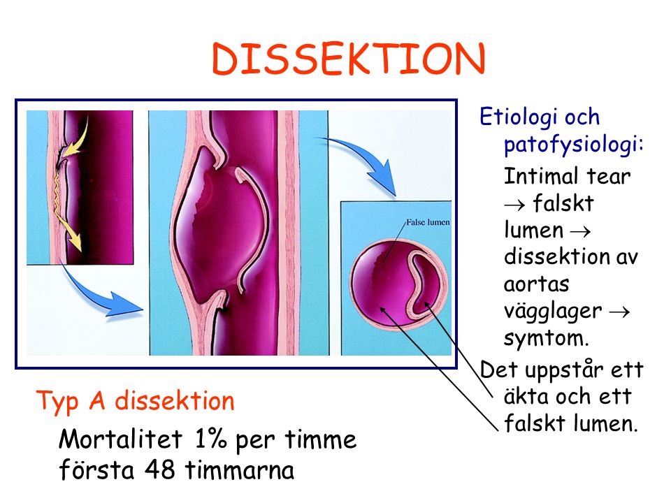 DISSEKTION Etiologi och patofysiologi: Intimal tear  falskt lumen  dissektion av aortas vägglager  symtom.