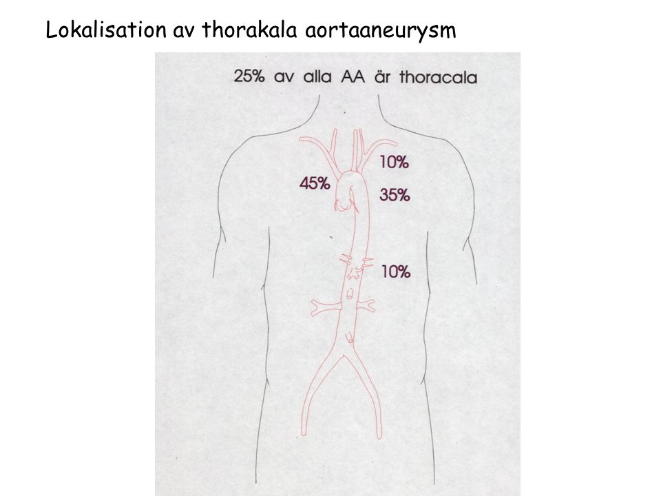 Lokalisation av thorakala aortaaneurysm