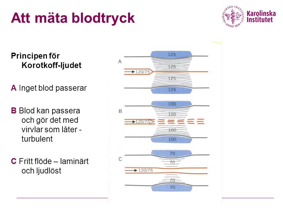 Principen för Korotkoff-ljudet A Inget blod passerar B Blod kan passera och gör det med virvlar som låter - turbulent C Fritt flöde – laminärt och ljudlöst Att mäta blodtryck