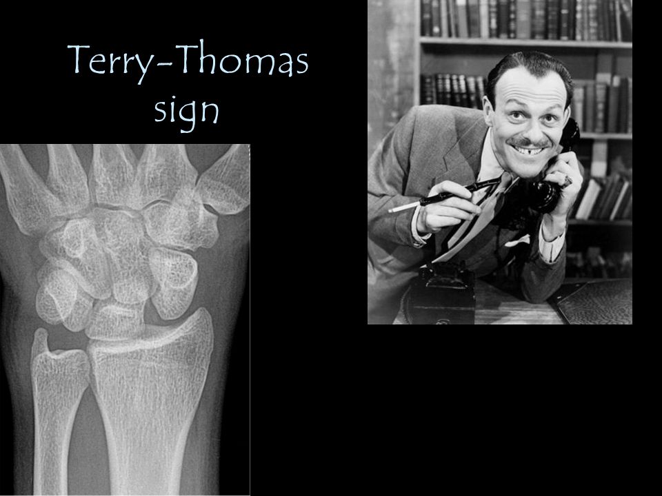 Terry-Thomas sign